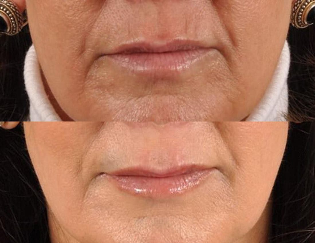 Tear Trough Filler Before & After Gallery - Patient 354015 - Image 3