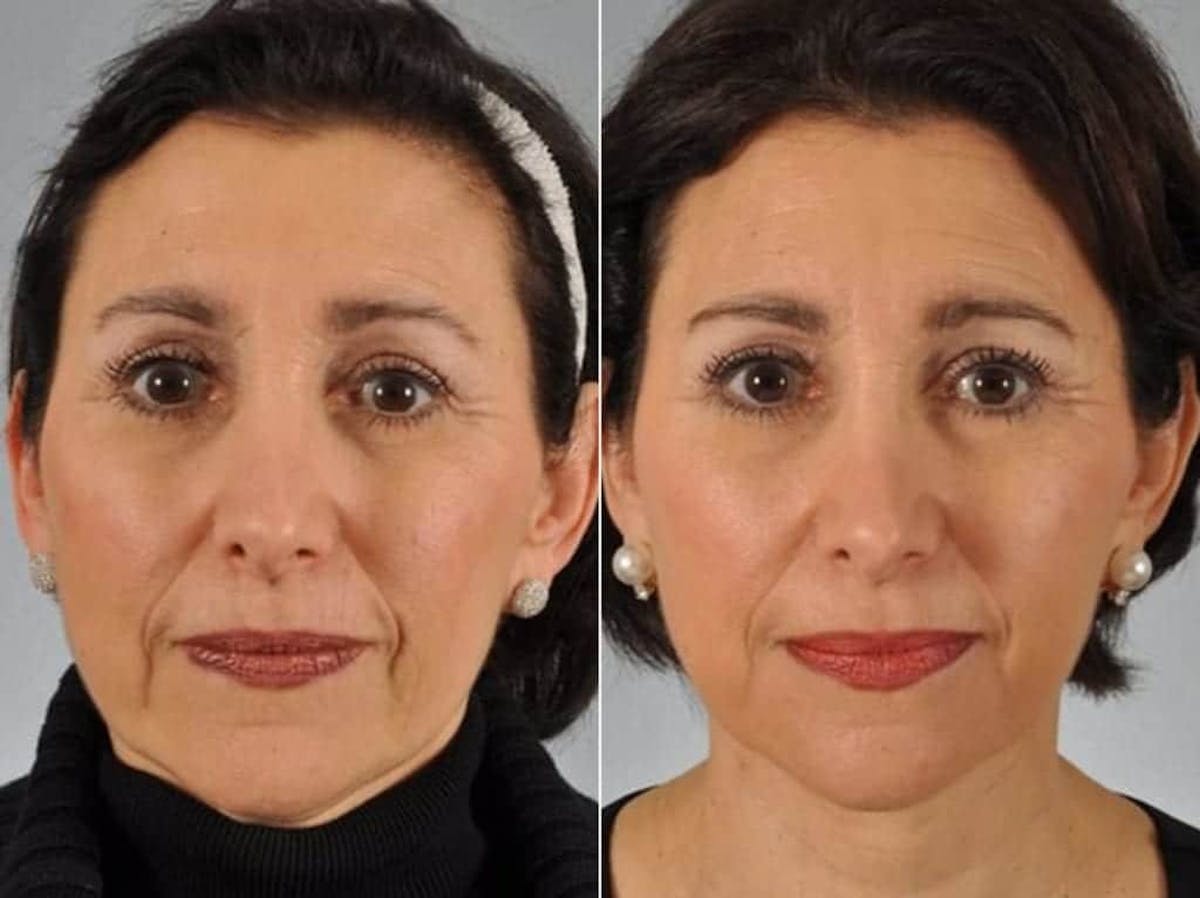 Tear Trough Filler Before & After Gallery - Patient 223748 - Image 1