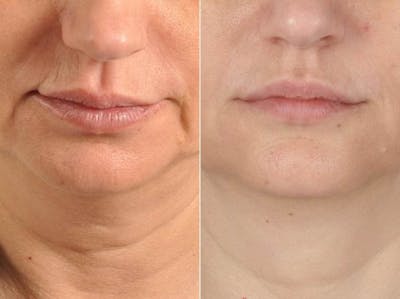 Tear Trough Filler Before & After Gallery - Patient 312998 - Image 2