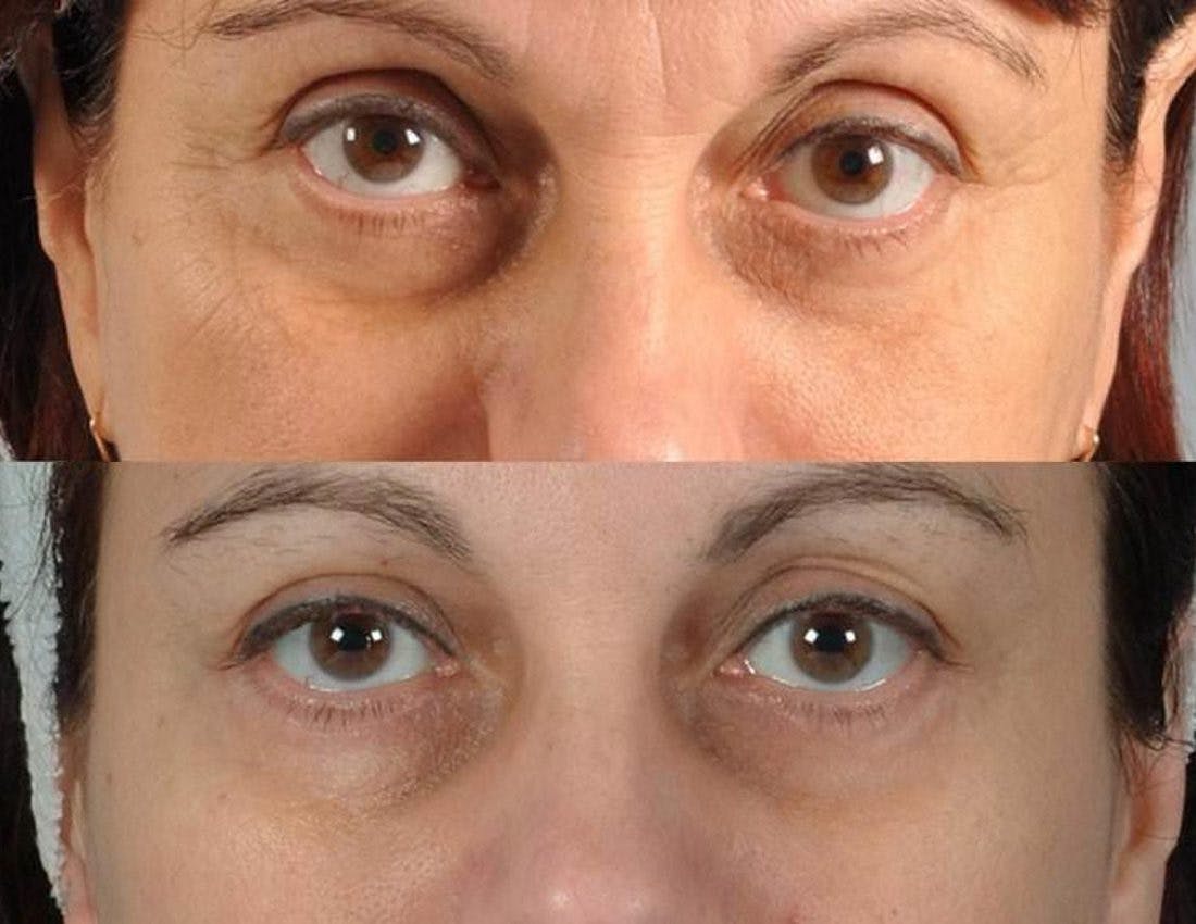 Tear Trough Filler Before & After Gallery - Patient 312998 - Image 3