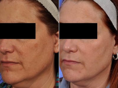 BBL (IPL Treatments) Before & After Gallery - Patient 124449 - Image 2