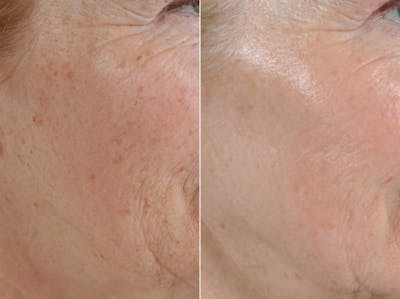 BBL (IPL Treatments) Before & After Gallery - Patient 159075 - Image 2