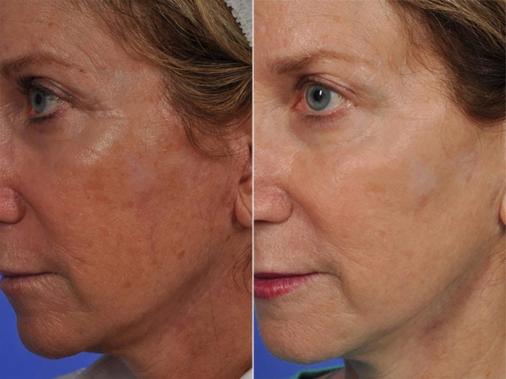 BBL (IPL Treatments) Before & After Gallery - Patient 142112 - Image 2