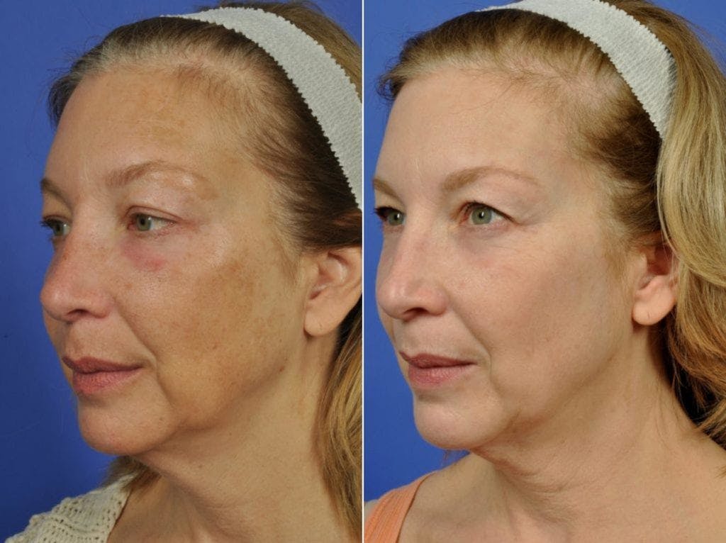 BBL (IPL Treatments) Before & After Gallery - Patient 380409 - Image 1