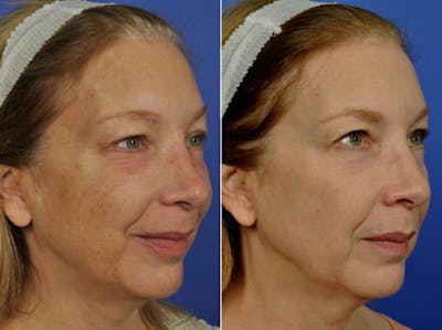 BBL (IPL Treatments) Before & After Gallery - Patient 380409 - Image 2