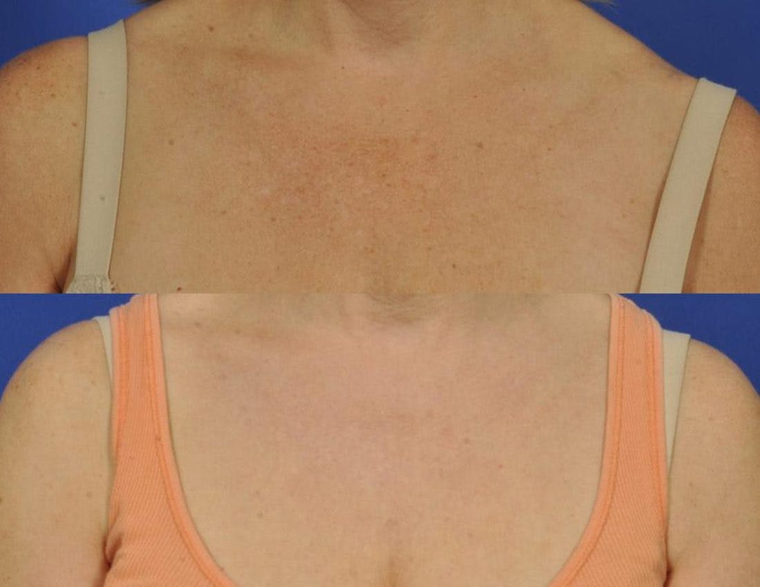BBL (IPL Treatments) Before & After Gallery - Patient 380409 - Image 3