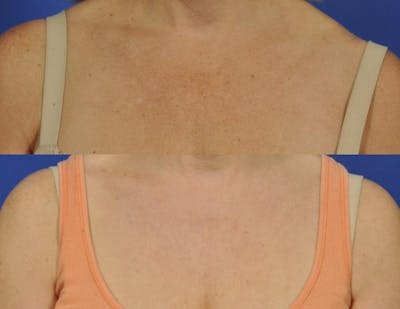 BBL (IPL Treatments) Before & After Gallery - Patient 380409 - Image 3