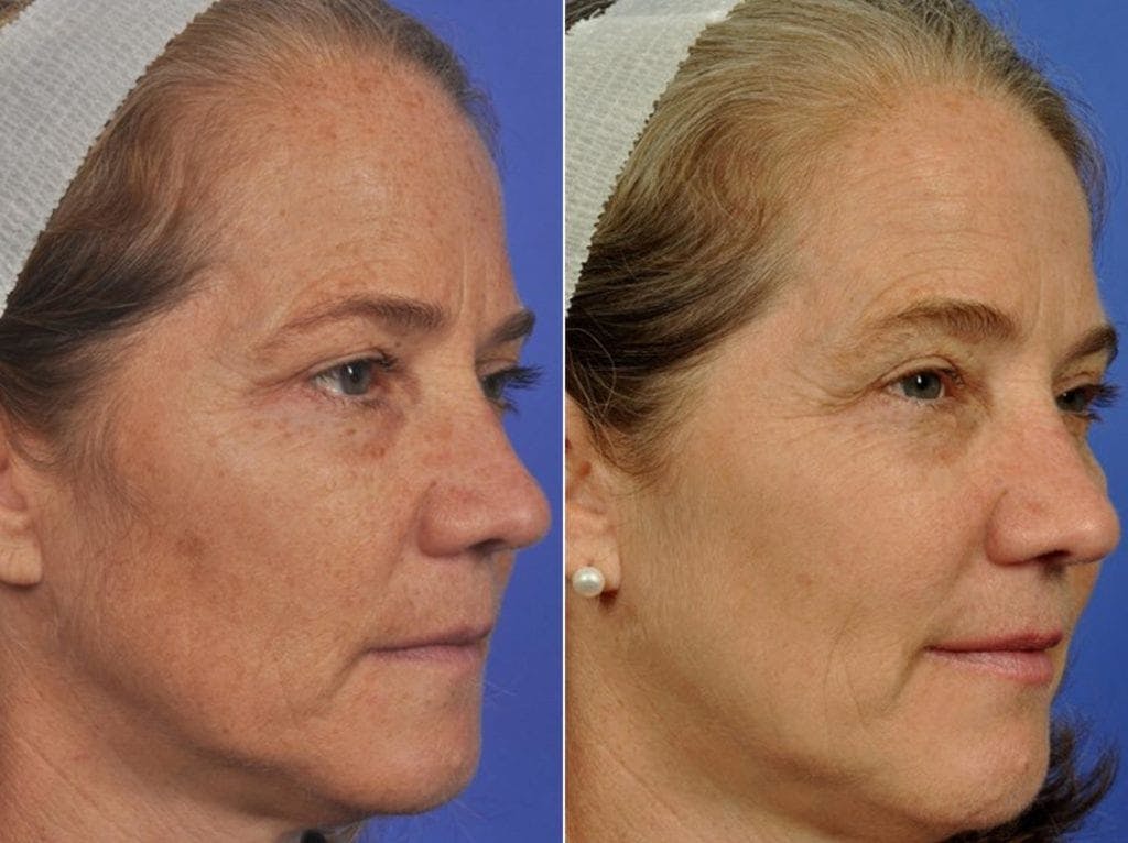 BBL (IPL Treatments) Before & After Gallery - Patient 718560 - Image 1