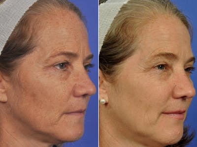BBL (IPL Treatments) Before & After Gallery - Patient 718560 - Image 1