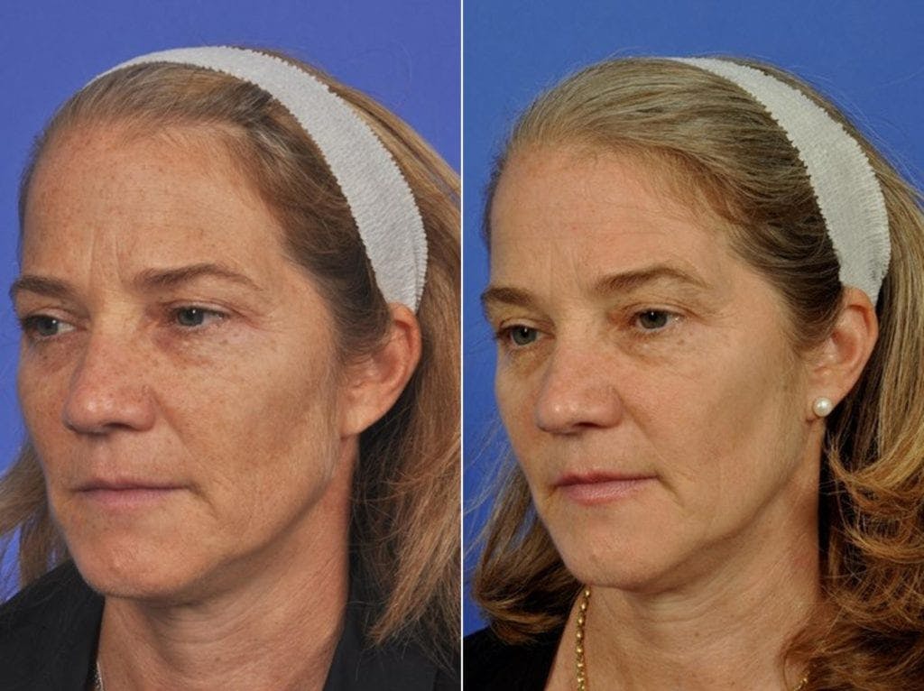BBL (IPL Treatments) Before & After Gallery - Patient 718560 - Image 2