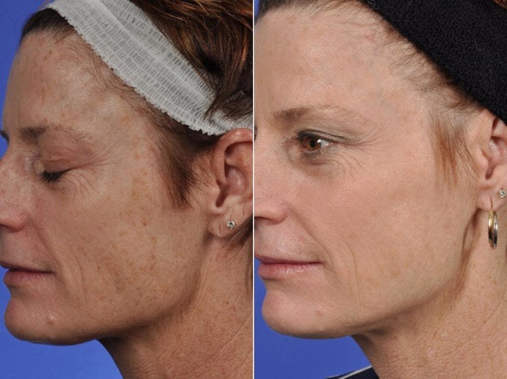BBL (IPL Treatments) Before & After Gallery - Patient 253534 - Image 2
