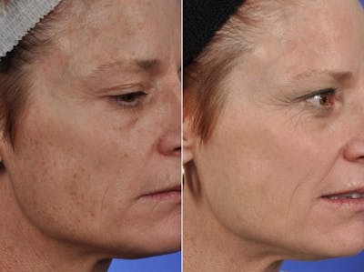 BBL (IPL Treatments) Before & After Gallery - Patient 253534 - Image 3