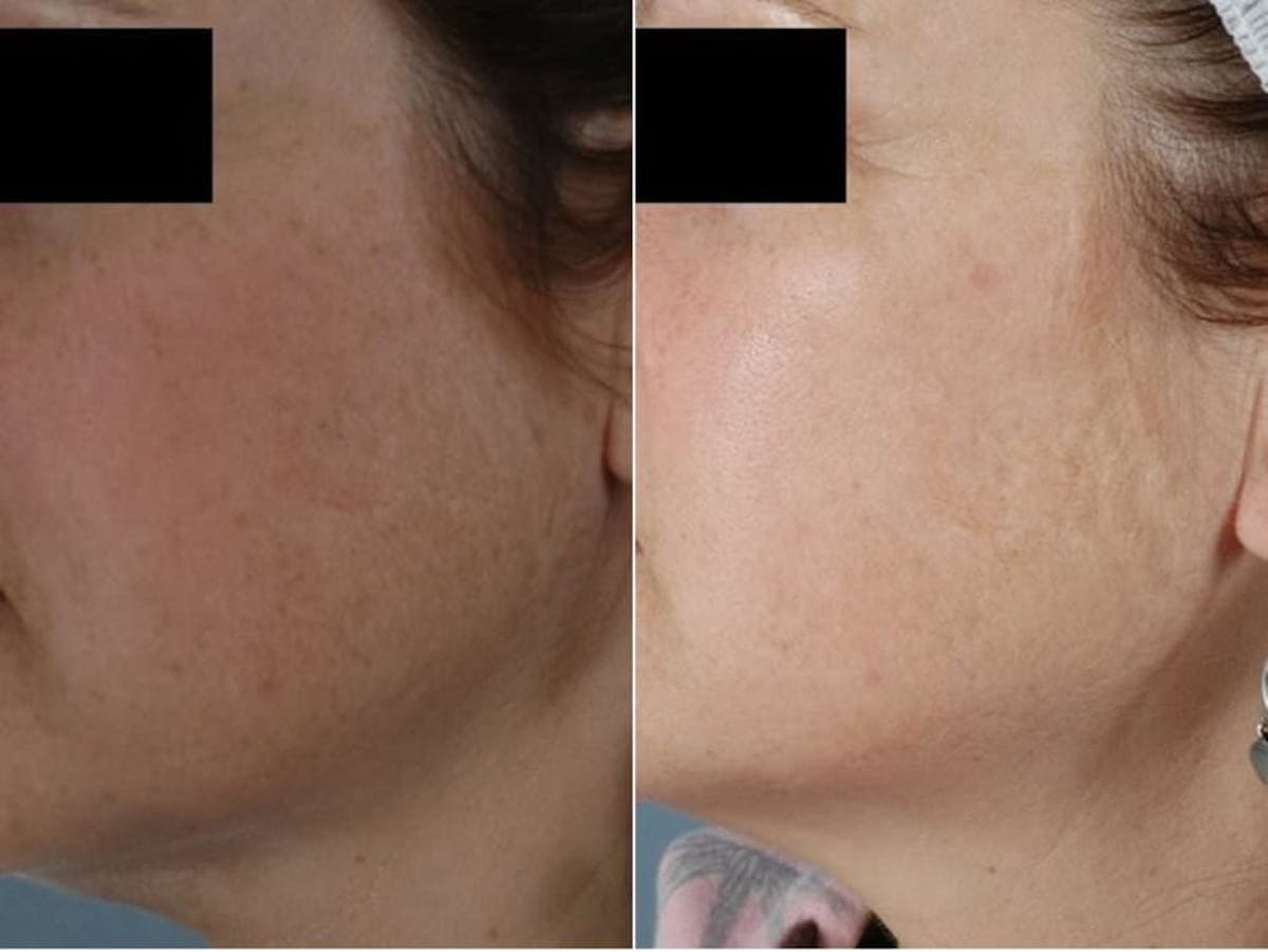 BBL (IPL Treatments) Before & After Gallery - Patient 340244 - Image 1