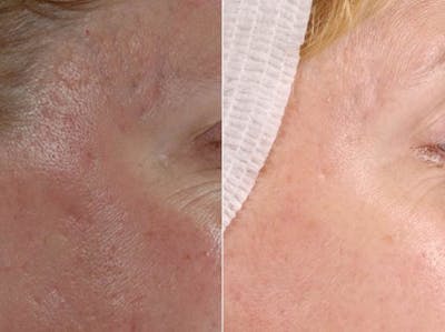 BBL (IPL Treatments) Before & After Gallery - Patient 213532 - Image 1
