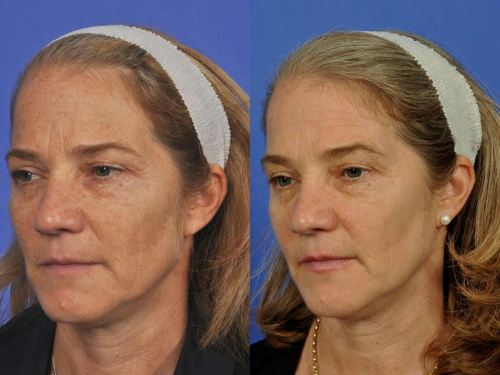 BBL (IPL Treatments) Before & After Gallery - Patient 400774 - Image 1