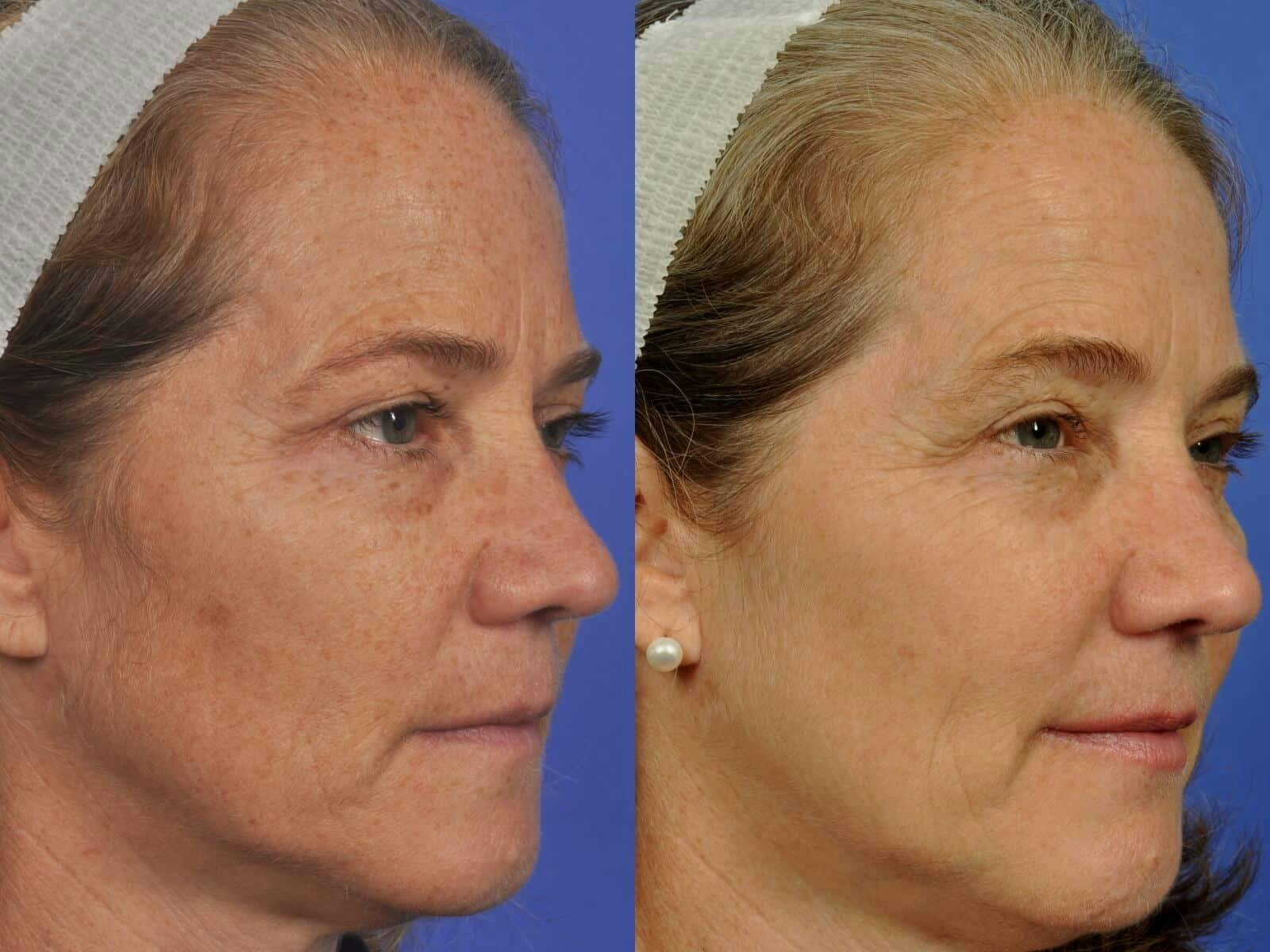 BBL (IPL Treatments) Before & After Gallery - Patient 400774 - Image 2