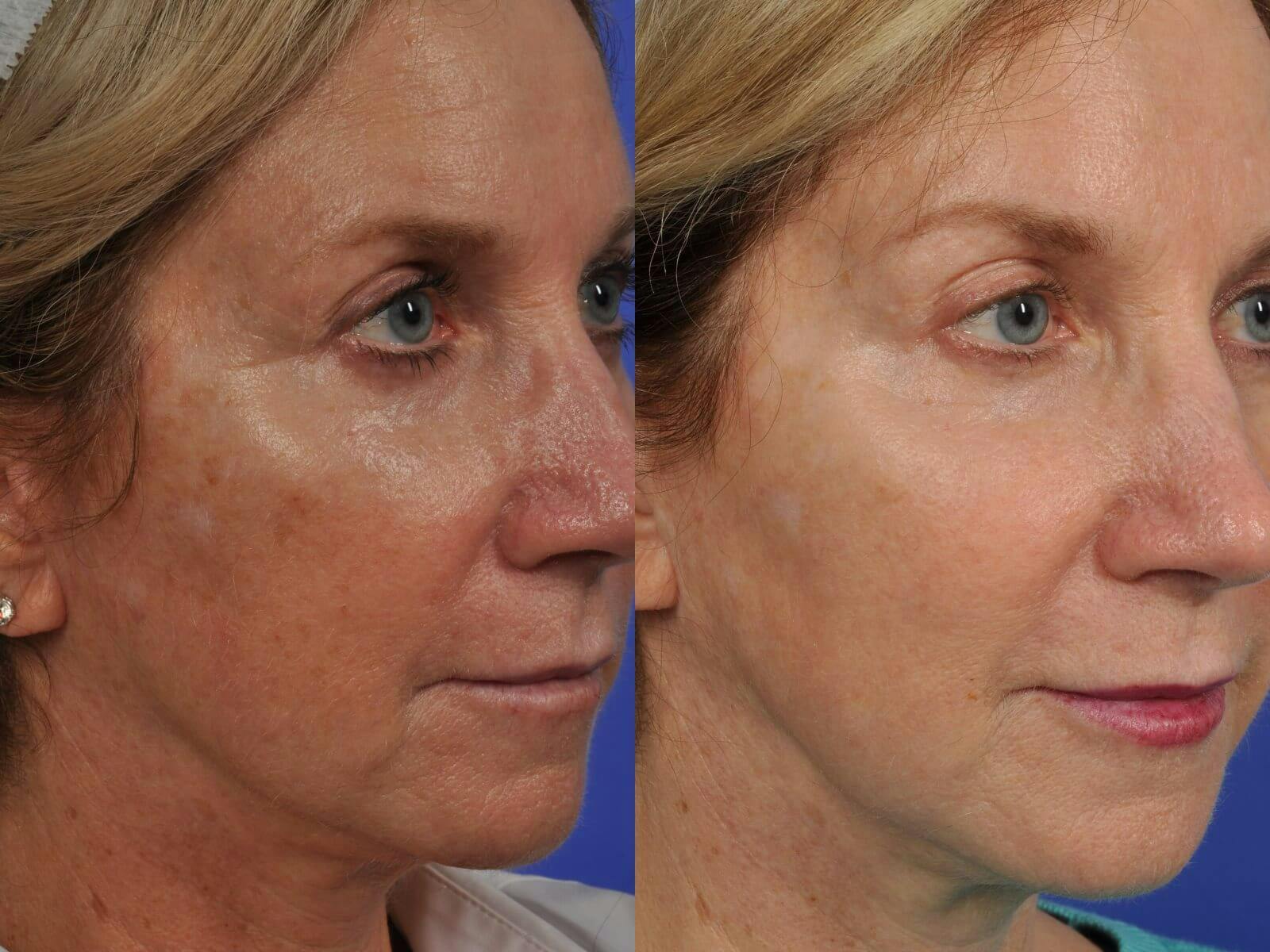 BBL (IPL Treatments) Before & After Gallery - Patient 281776 - Image 2
