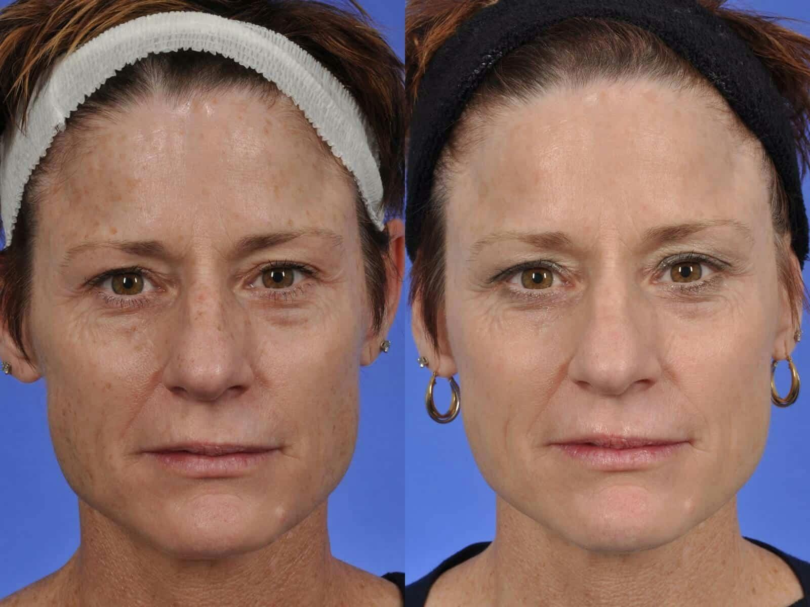 BBL (IPL Treatments) Before & After Gallery - Patient 158366 - Image 1