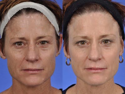 BBL (IPL Treatments) Before & After Gallery - Patient 158366 - Image 1