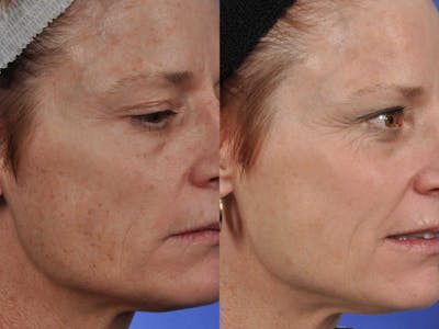 BBL (IPL Treatments) Before & After Gallery - Patient 158366 - Image 2
