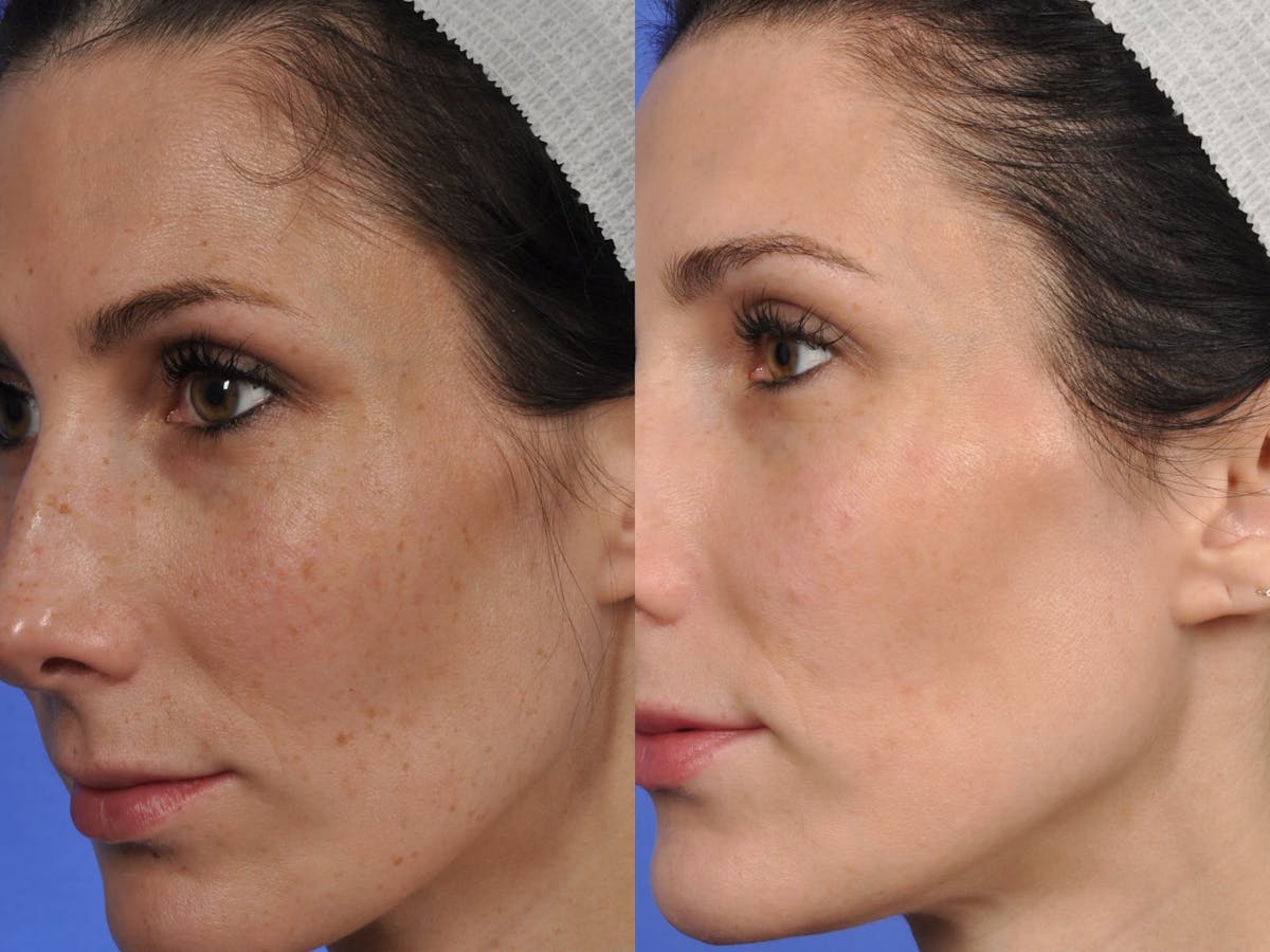 Clear & Brilliant Before & After Gallery - Patient 672257 - Image 1