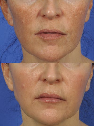 Clear & Brilliant Before & After Gallery - Patient 625528 - Image 1