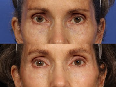 Clear & Brilliant Before & After Gallery - Patient 190363 - Image 1