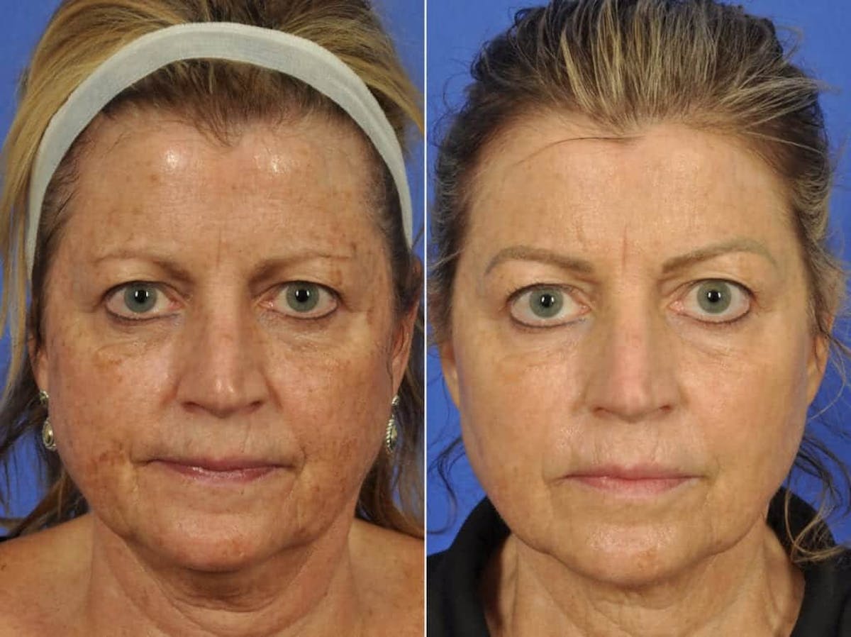 Clear & Brilliant Before & After Gallery - Patient 318273 - Image 1