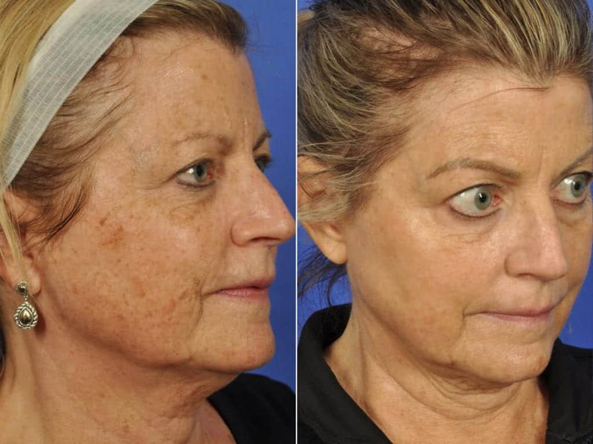 Clear & Brilliant Before & After Gallery - Patient 318273 - Image 2