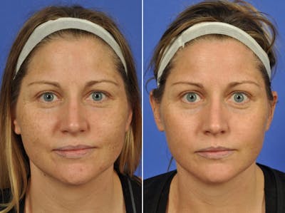 Clear & Brilliant Before & After Gallery - Patient 516664 - Image 1