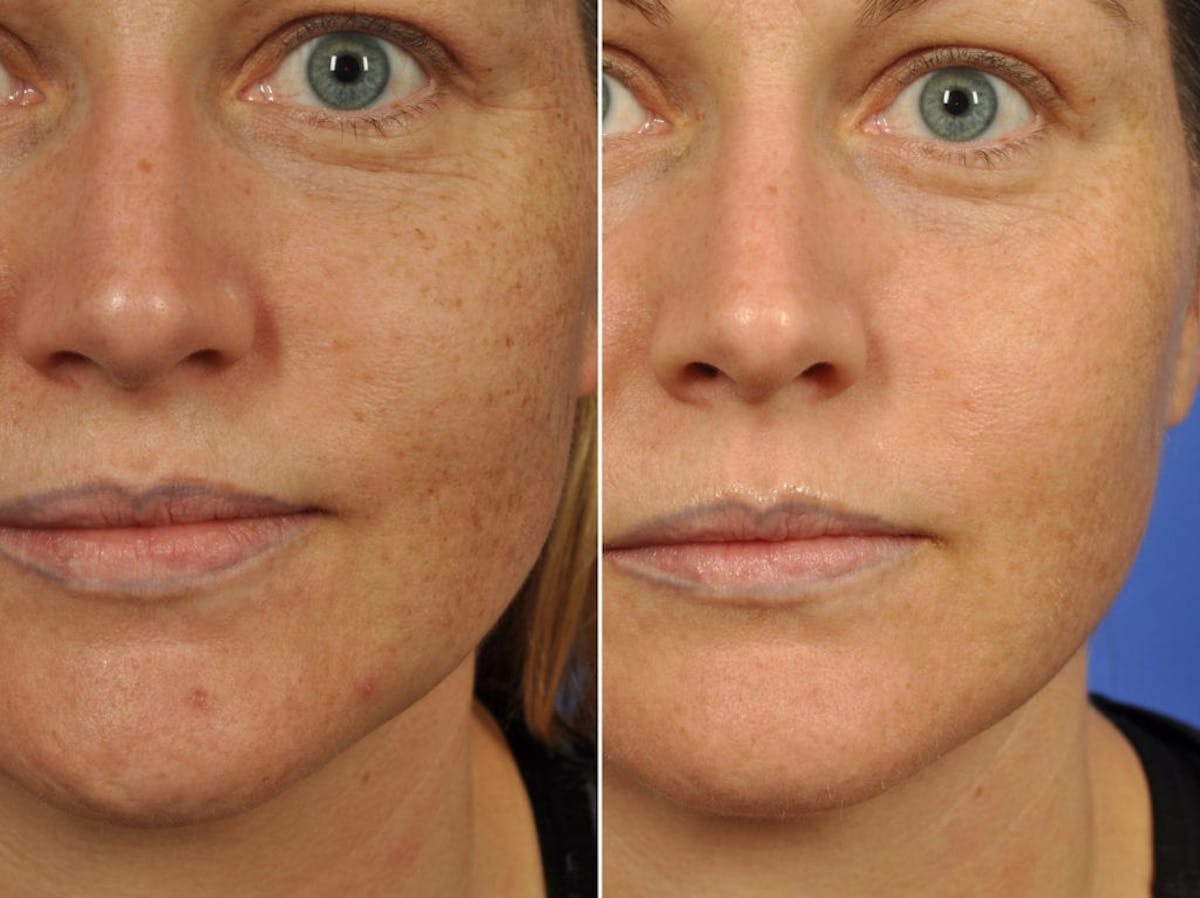 Clear & Brilliant Before & After Gallery - Patient 516664 - Image 2
