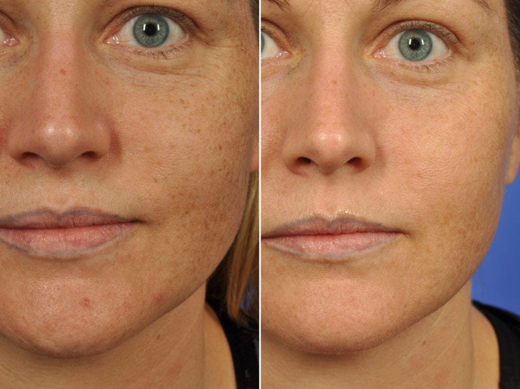 Clear & Brilliant Before & After Gallery - Patient 516664 - Image 2
