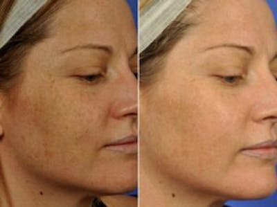 Clear & Brilliant Before & After Gallery - Patient 516664 - Image 4