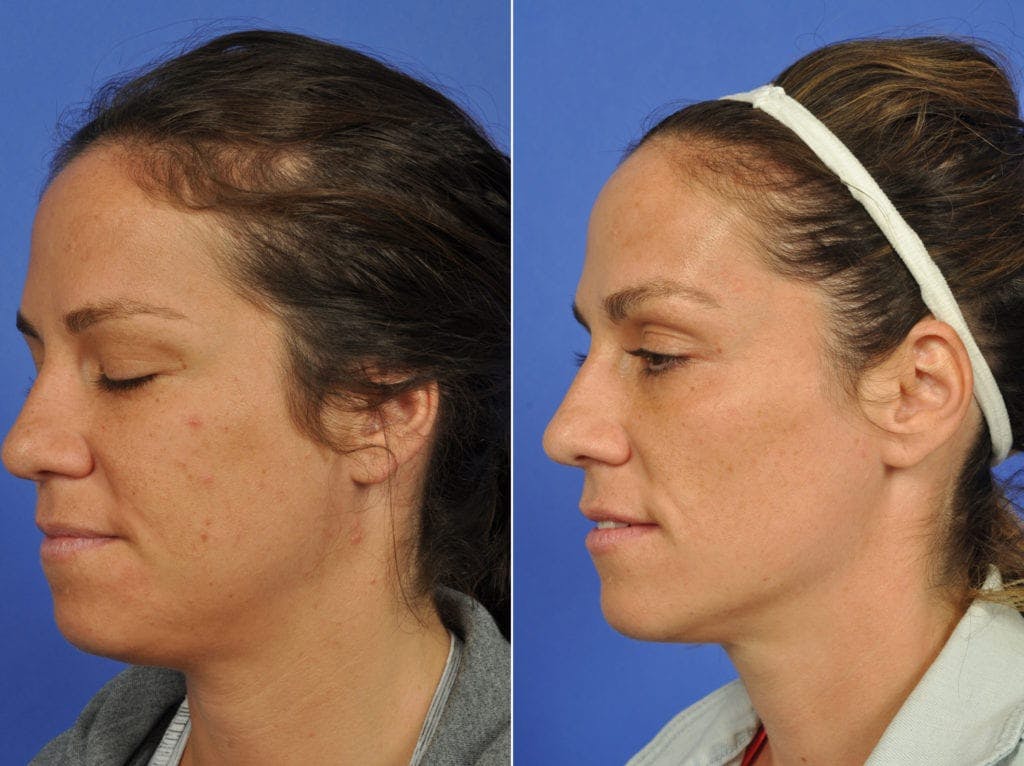 Clear & Brilliant Before & After Gallery - Patient 308951 - Image 1