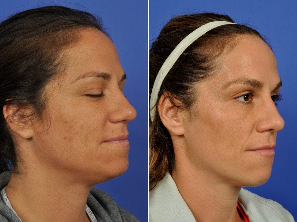 Clear & Brilliant Before & After Gallery - Patient 308951 - Image 2