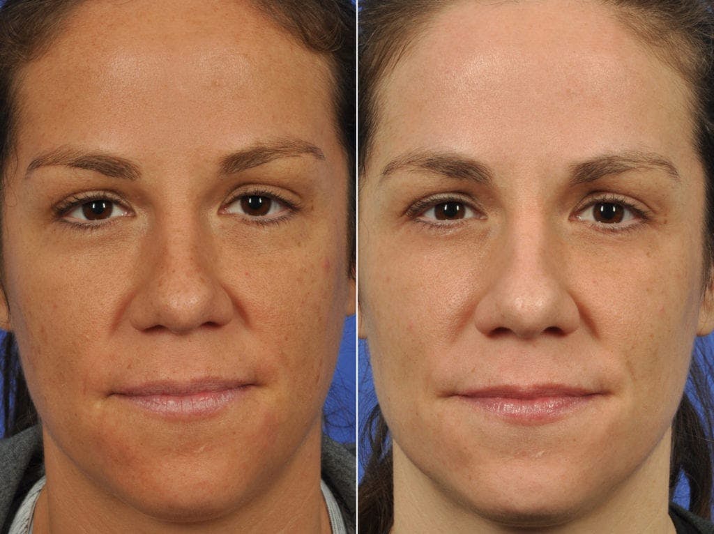 Clear & Brilliant Before & After Gallery - Patient 308951 - Image 3