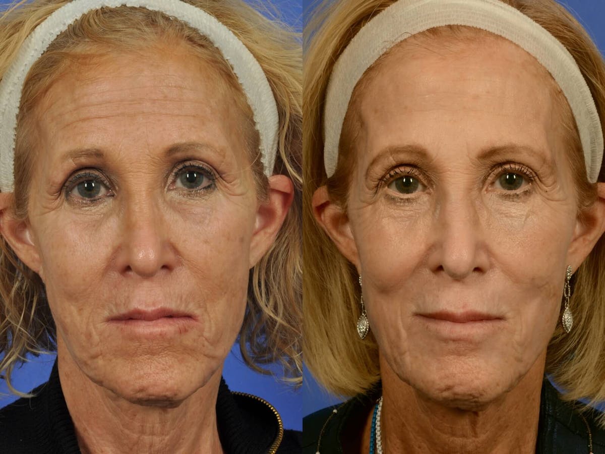 Hetter Peel Before & After Gallery - Patient 285776 - Image 1