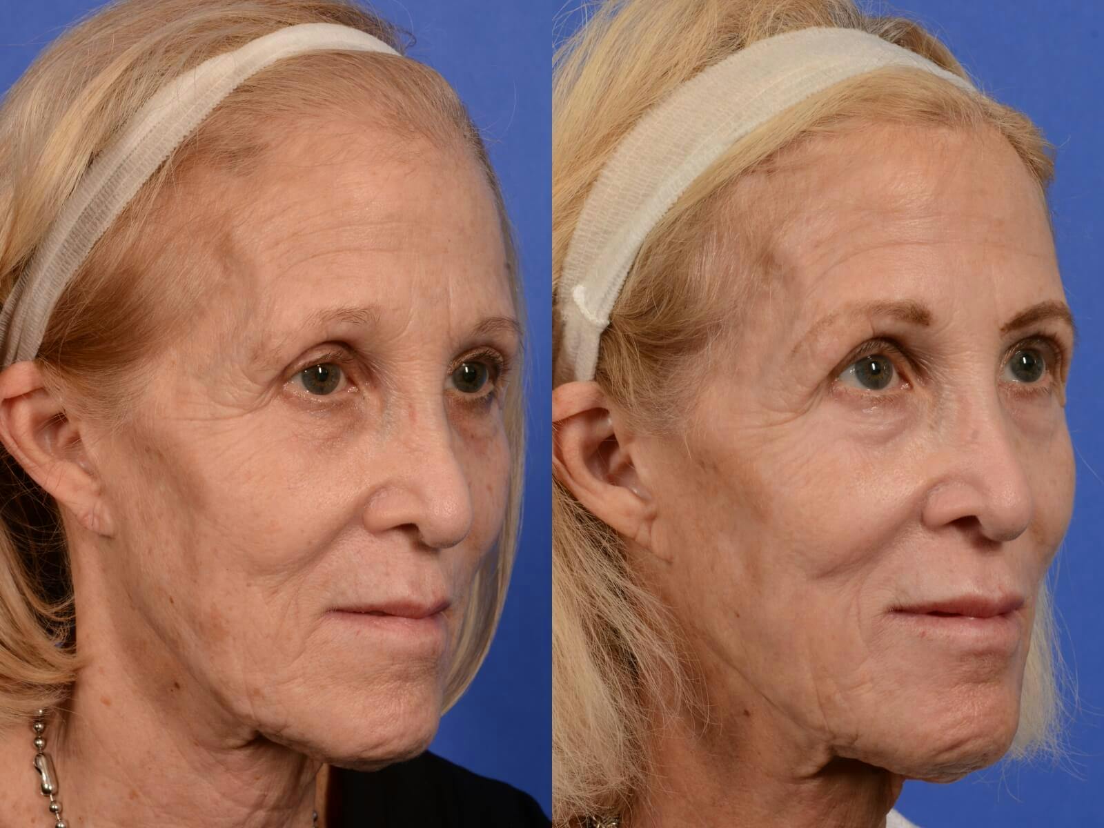 Hetter Peel Before & After Gallery - Patient 285776 - Image 2