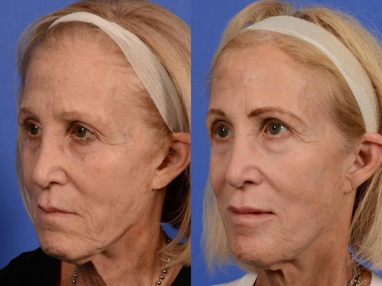 Hetter Peel Before & After Gallery - Patient 285776 - Image 3