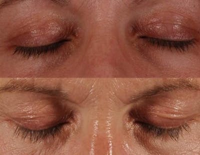 Revitalash (& Other Topicals for Lash Enhancement)  Before & After Gallery - Patient 102151 - Image 1