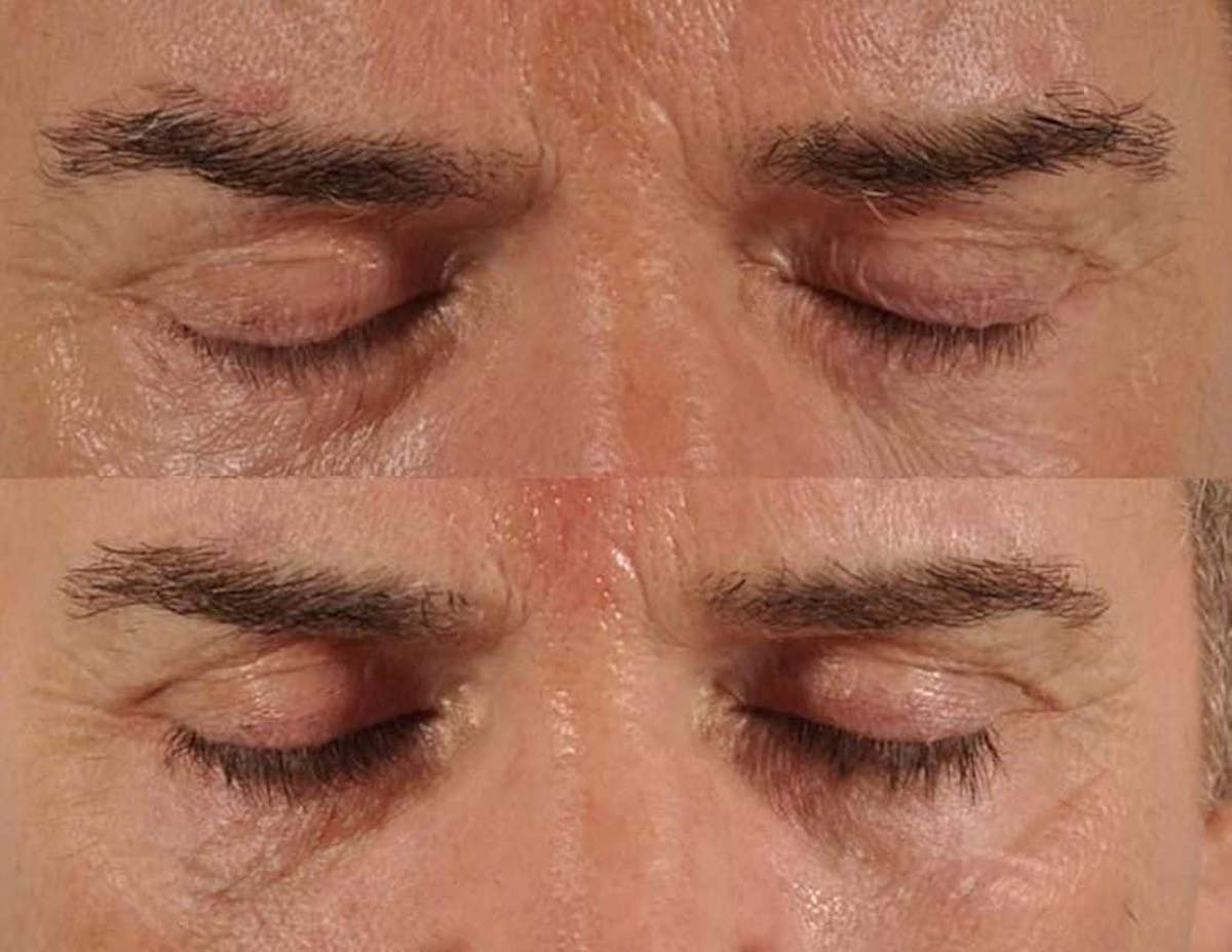 Revitalash (& Other Topicals for Lash Enhancement)  Before & After Gallery - Patient 272387 - Image 1
