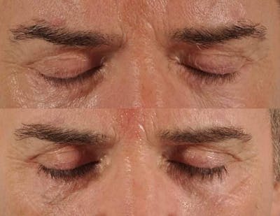 Revitalash (& Other Topicals for Lash Enhancement)  Before & After Gallery - Patient 272387 - Image 1