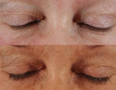 Revitalash (& Other Topicals for Lash Enhancement)  Before & After Gallery - Patient 291411 - Image 1