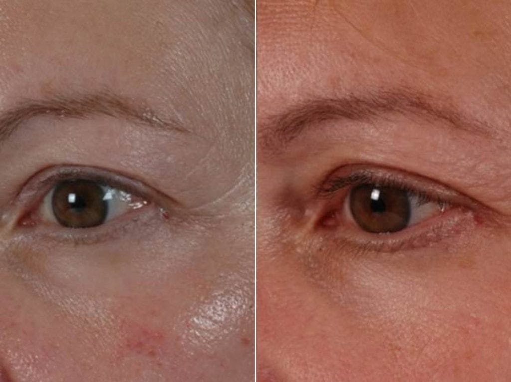 Revitalash (& Other Topicals for Lash Enhancement)  Before & After Gallery - Patient 291411 - Image 2