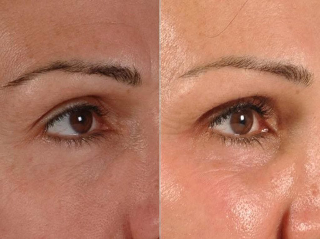 Revitalash (& Other Topicals for Lash Enhancement)  Before & After Gallery - Patient 291411 - Image 3