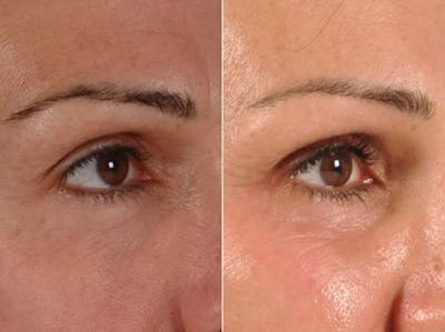 Revitalash (& Other Topicals for Lash Enhancement)  Before & After Gallery - Patient 291411 - Image 3