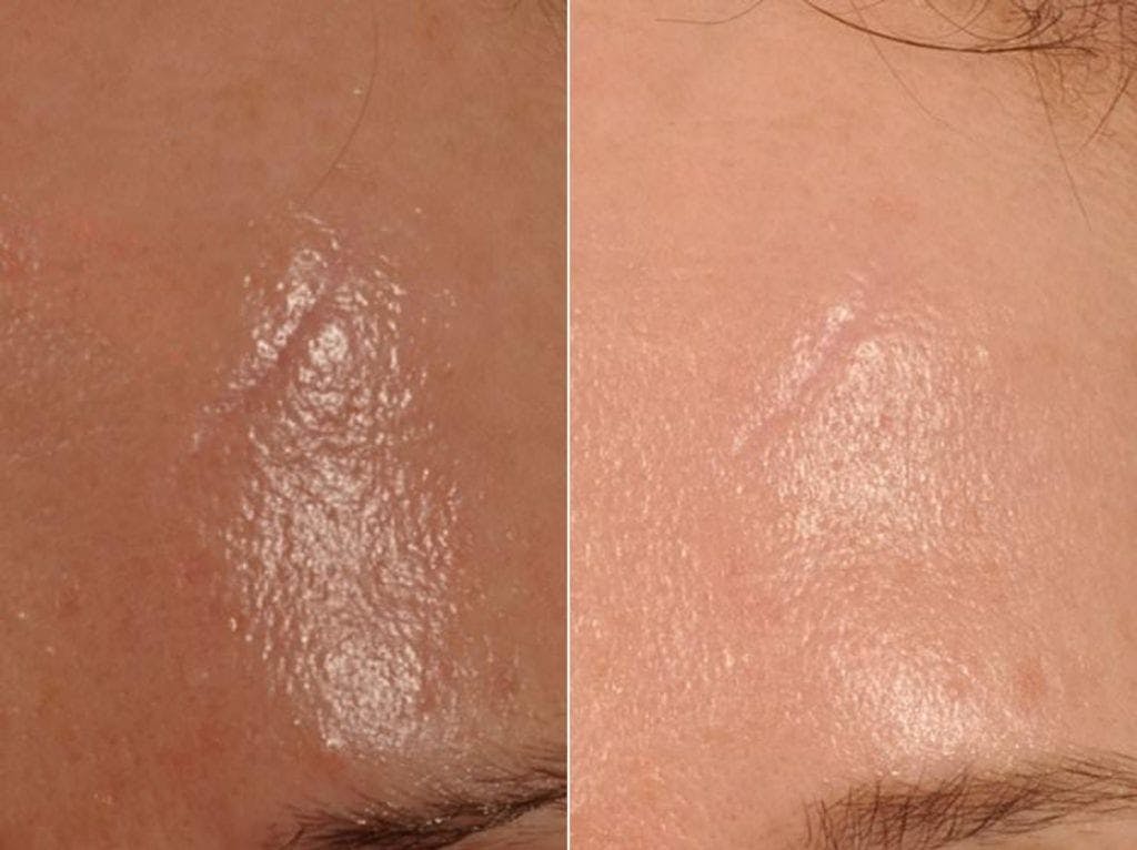Microneedling Before & After Gallery - Patient 124140 - Image 1