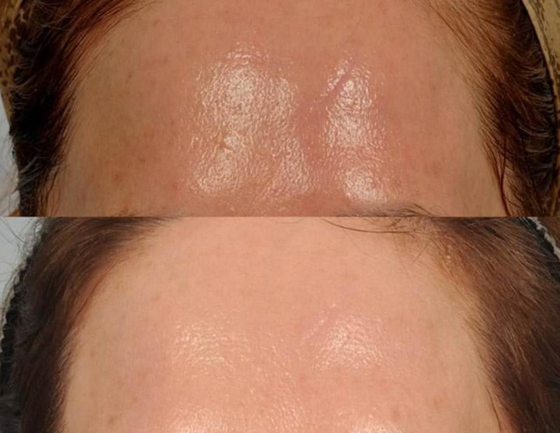 Microneedling Before & After Gallery - Patient 124140 - Image 2