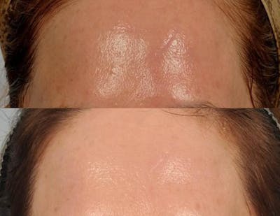 Microneedling Before & After Gallery - Patient 124140 - Image 2