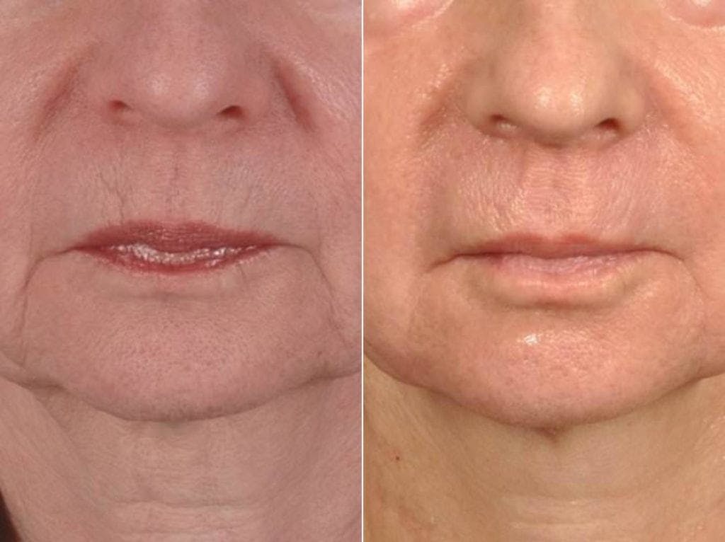 Microneedling Before & After Gallery - Patient 389541 - Image 1
